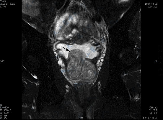 MR平扫冠状面T2WI脂肪抑制成像示前列腺增生突入膀胱（→）