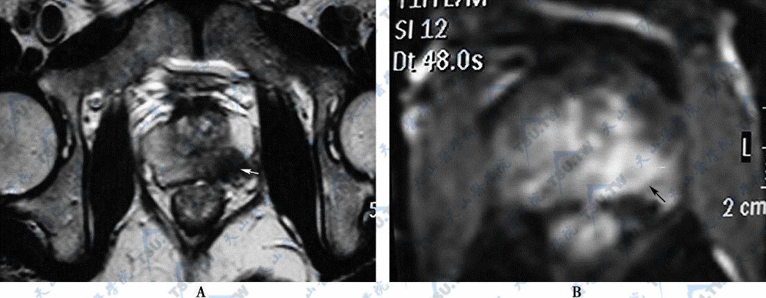A．MR平扫横断面T2WI，示前列腺外周带癌（→）　B．MR横断面T1WI增强扫描示前列腺癌明显强化（→）