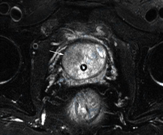 MR平扫横断面T2WI脂肪抑制成像示前列腺增生并内腺癌（→），癌灶边界不清晰，无环形低信号包膜
