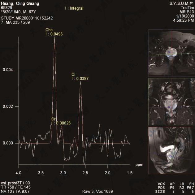 示前列腺内腺癌MRS谱线：Cit峰降低，Cho峰高耸