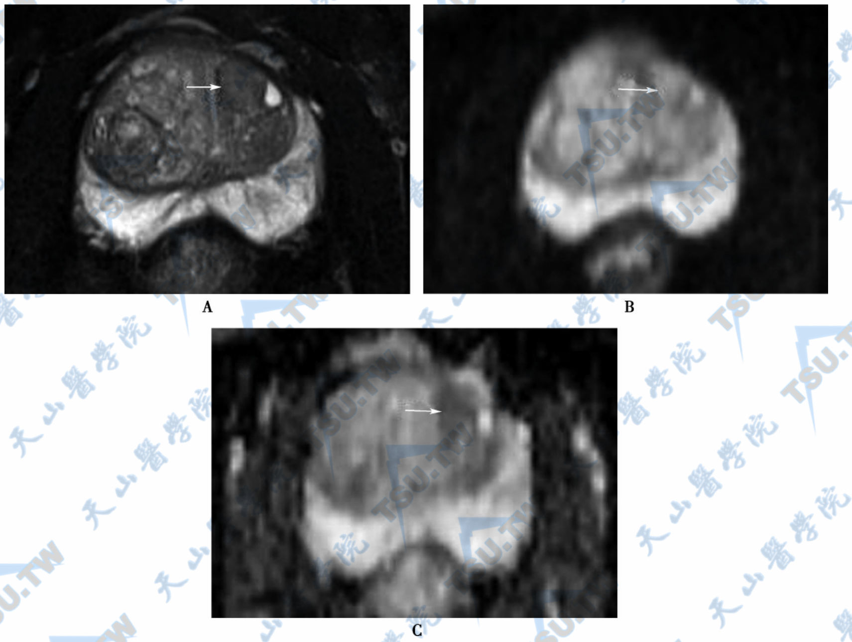 前列腺增生，MR平扫轴位T2WI图，间质为主的增生结节呈低信号