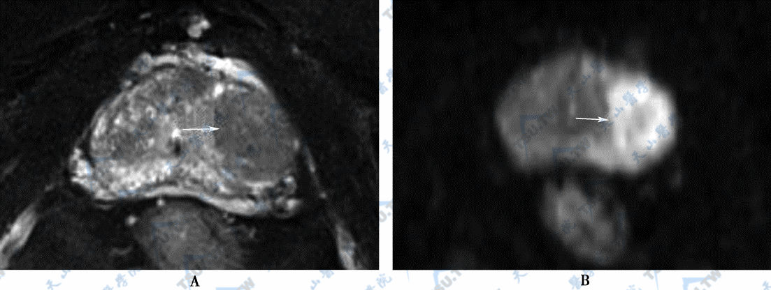 A．中央带前列腺癌，MR平扫轴位T2WI图，癌灶呈低信号（→） B．中央带前列腺癌，MR平扫轴位DWI图，癌灶呈高信号（→）　C．中央带前列腺癌，MR平扫轴位ADC图，癌灶呈低信号（→）