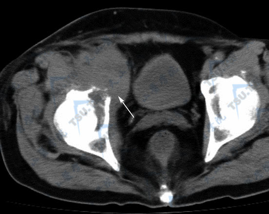 CT横断面平扫示右髋骨溶骨性破坏，周围见不规则软组织肿块（→）