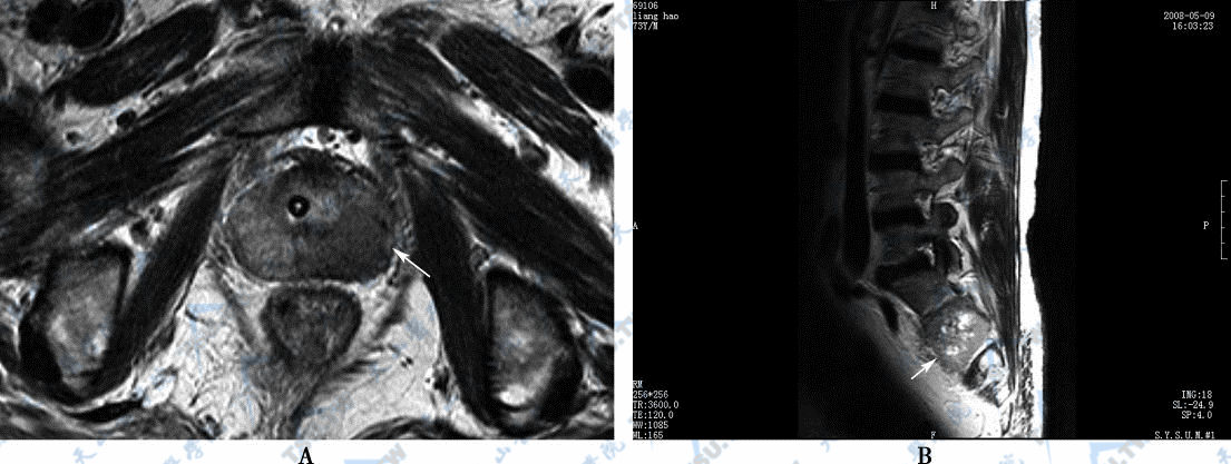 A．MR横断面T2WI，示前列腺左侧外周带癌（→）　B．患者骶2椎体骨转移（→）
