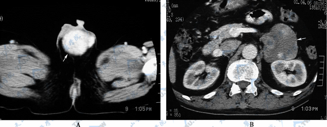 A．CT横断面增强扫描，示睾丸癌（→）　B．患者腹膜后淋巴结转移（→）