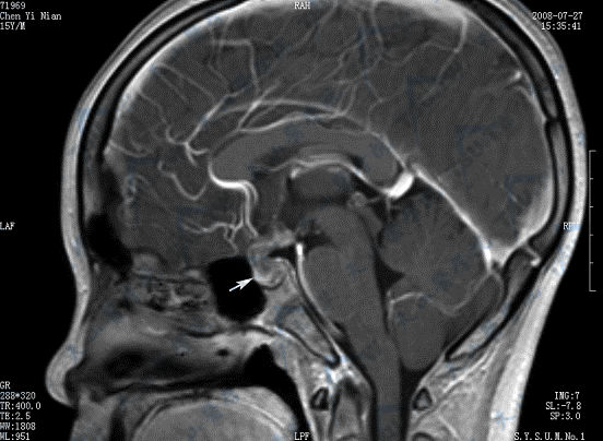 性腺功能减退：垂体腺瘤的MR磁共振成像