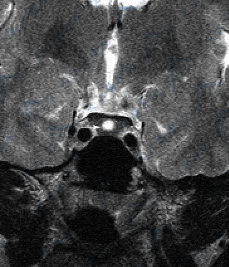 性腺功能减退：Rathke裂囊肿的MRI磁共振成像