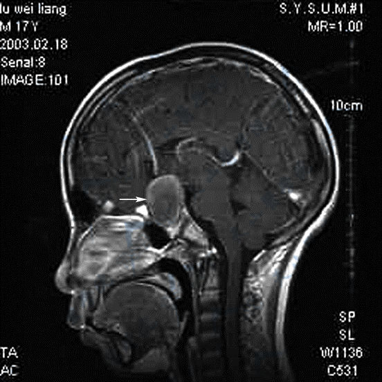 性腺功能减退：颅咽管瘤的MRI磁共振成像