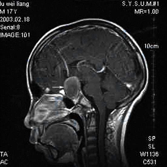 MR矢状面T1WI增强扫描示颅咽管囊肿（→）