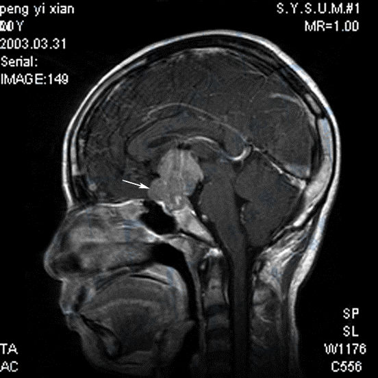 性腺功能减退：生殖细胞瘤的MRI磁共振成像