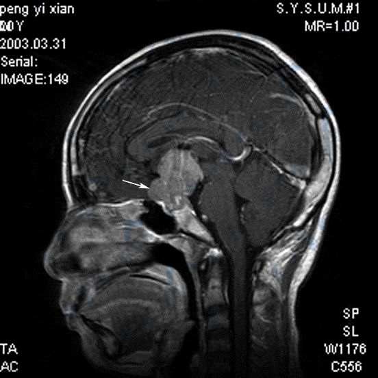 MR矢状面T1WI增强扫描示鞍上生殖细胞瘤（→）