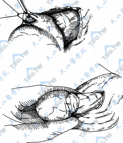 把附睾被膜和睾丸白膜间断缝合在一起