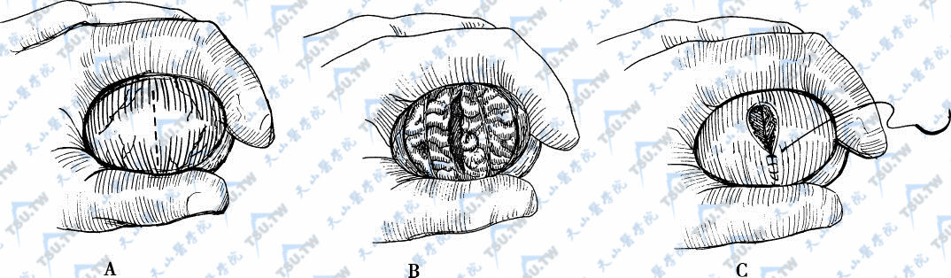 A．睾丸前中部、血管间的白膜作5～10mm的横切口，B．用双极电凝切开睾丸实质，检查并寻找白色或黄色的曲细精管，C．用带角针的5-0缝线缝合白膜切口及皮肤切口