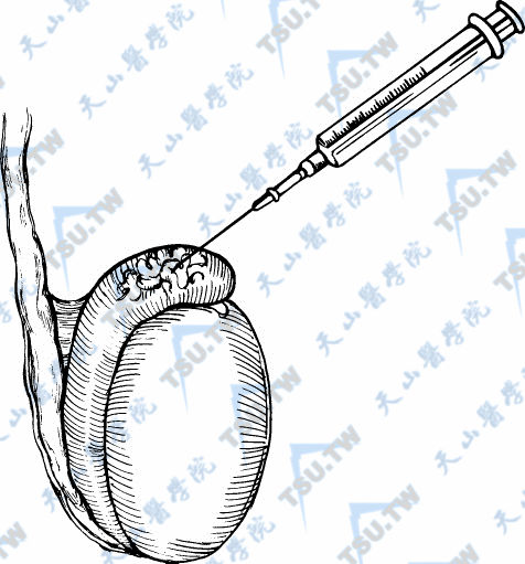 将一支5μl玻璃微量吸液管置于切口内，附睾液可通过虹吸作用进入管内