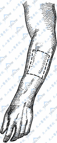 以桡动脉为中心，设计长10～12cm，宽12～14cm的皮瓣