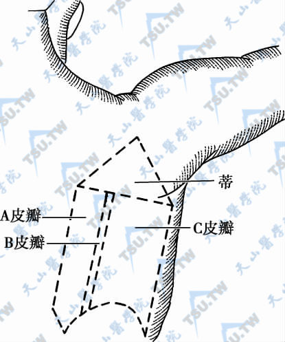 皮瓣设计