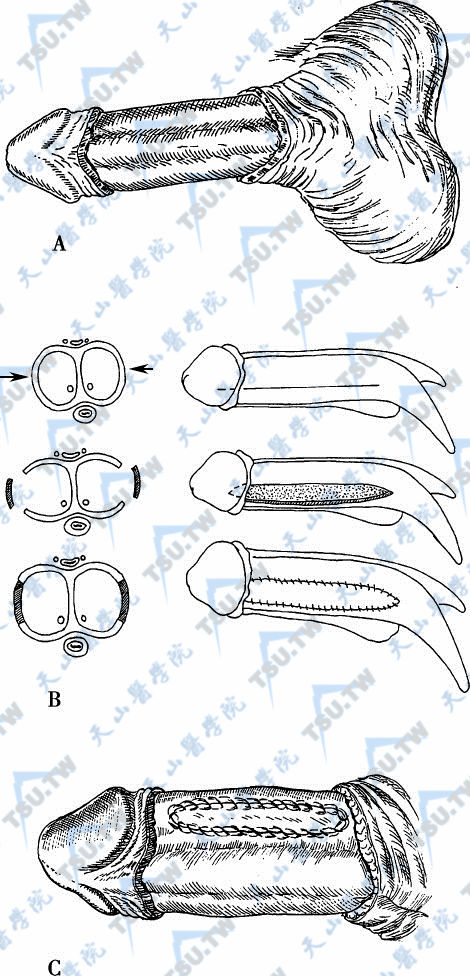 自体大隐静脉补片或人工血管补片植入海绵体白膜阴茎增粗手术
