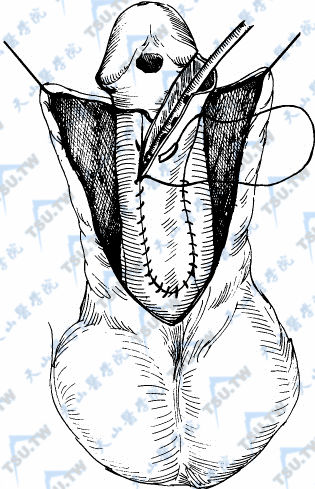 皮瓣和固有尿道远端作斜行间断外翻缝合并固定在白膜上