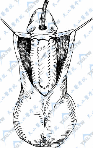 游离包皮尿道成形术详解