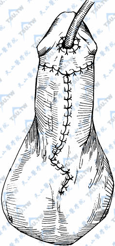 转移背侧包皮至腹侧分两层覆盖新尿道