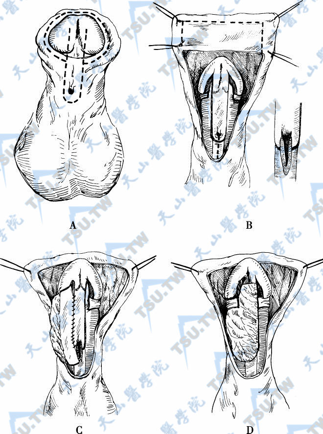 加盖带蒂包皮瓣尿道成形术