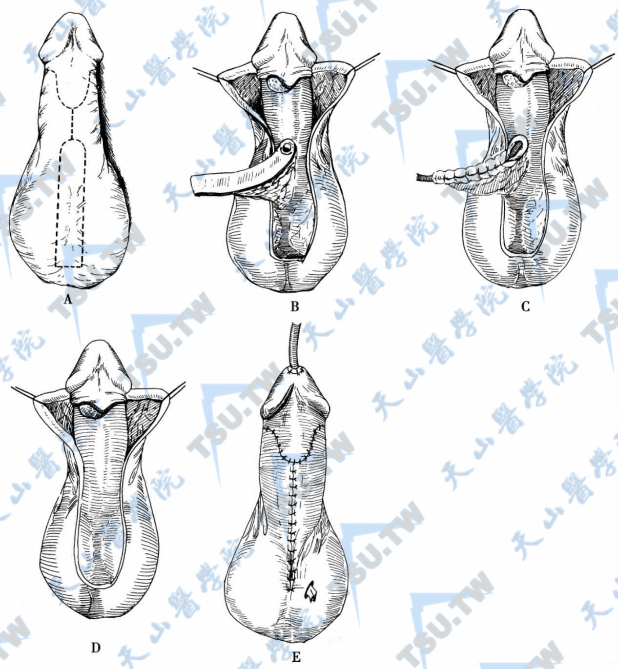 阴囊中隔皮瓣尿道成形术