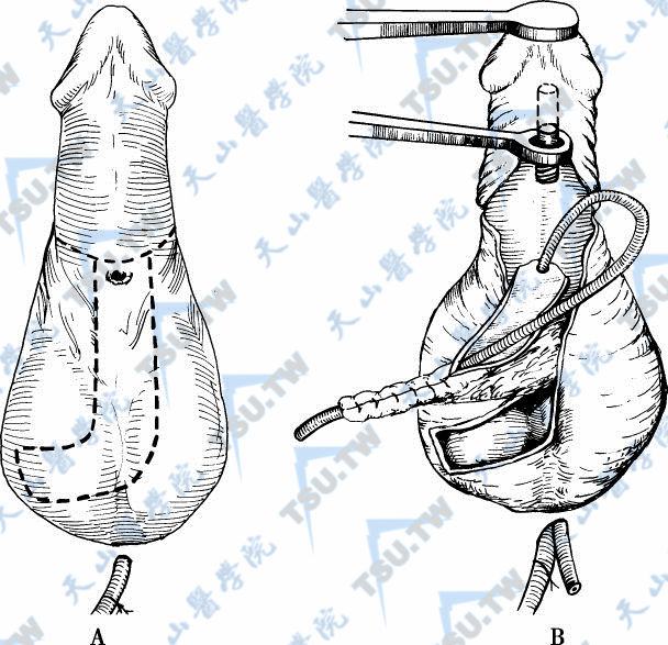 阴囊L形皮瓣一期尿道成形术
