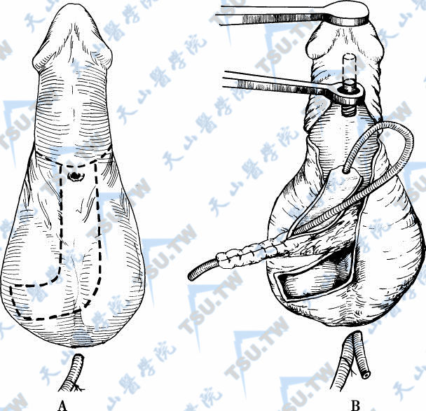 阴囊L形皮瓣一期尿道成形术 