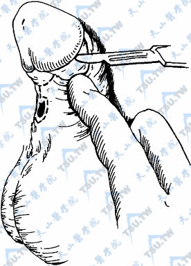阴茎切口