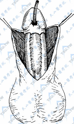尿道从阴茎头穿出