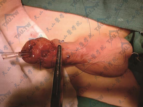 尿瘘手术外层皮下缝合