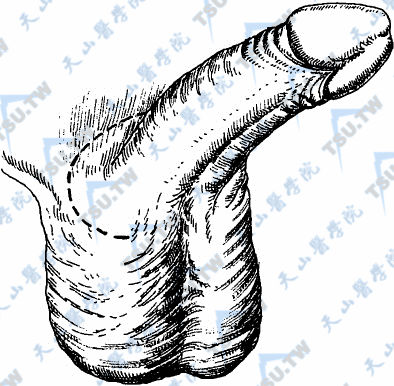 阴茎根部弧形切口 