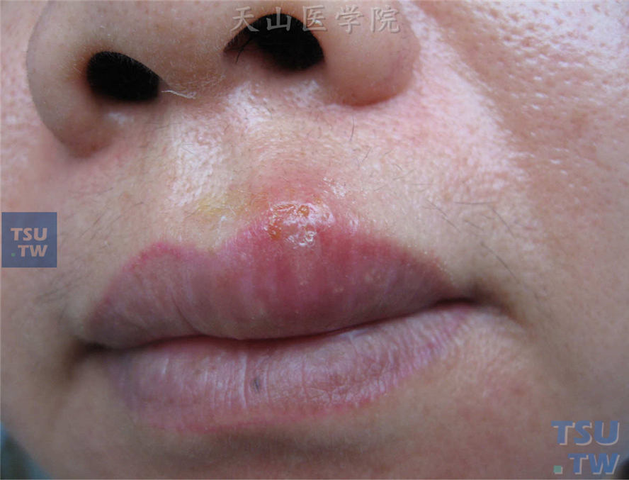 上唇水肿性红斑基础上群集性水疱，部分破溃表面结痂
