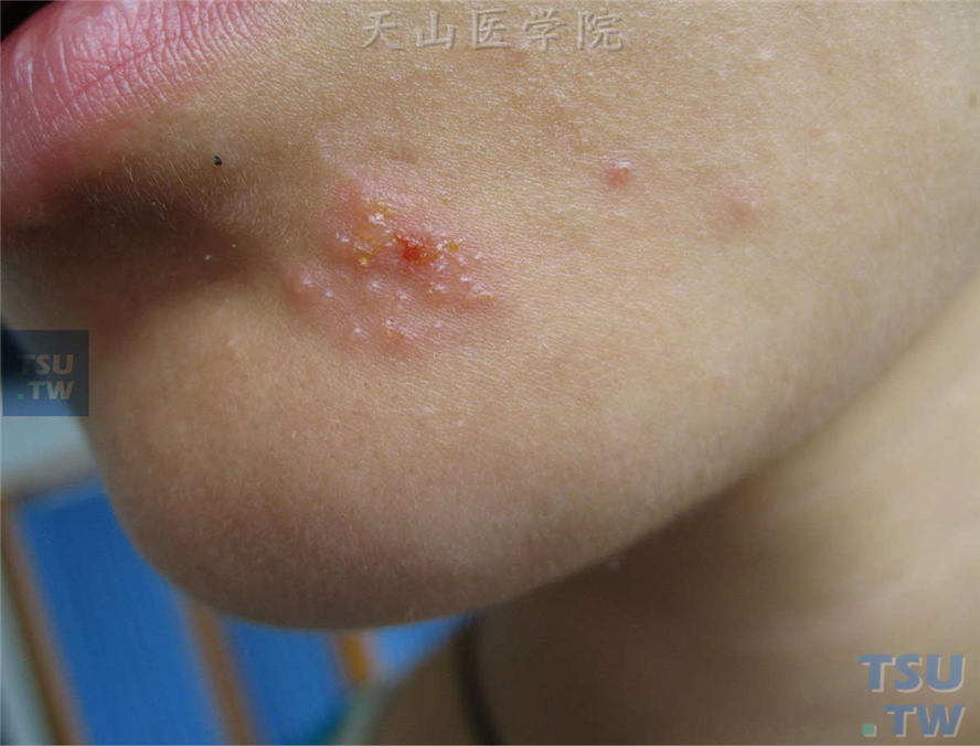 单纯疱疹（herpes simplex）症状表现