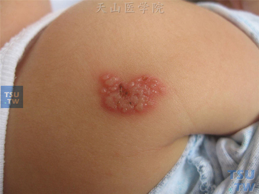 单纯疱疹(herpes simplex)症状表现