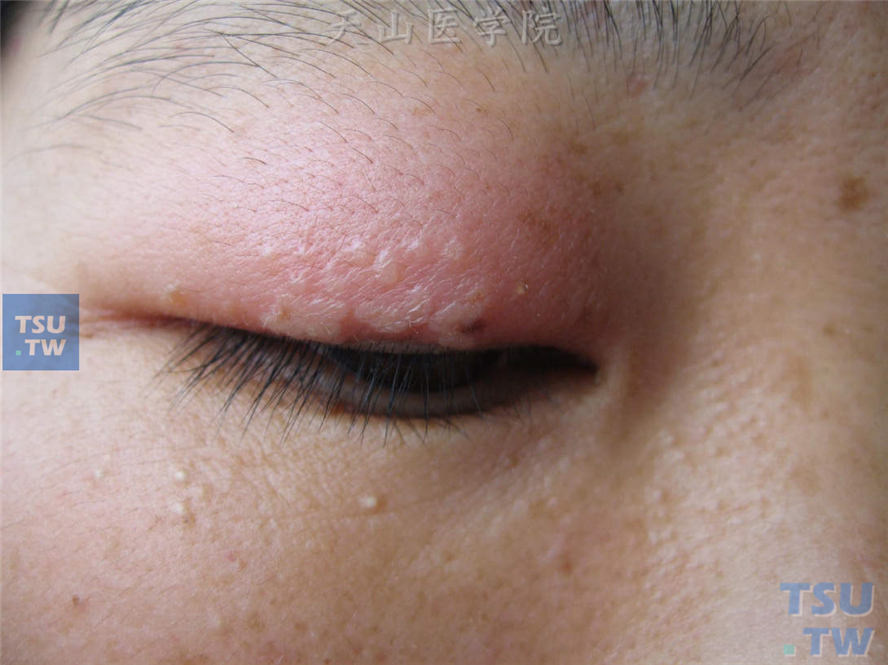 右上眼睑红斑基础上群集性水疱