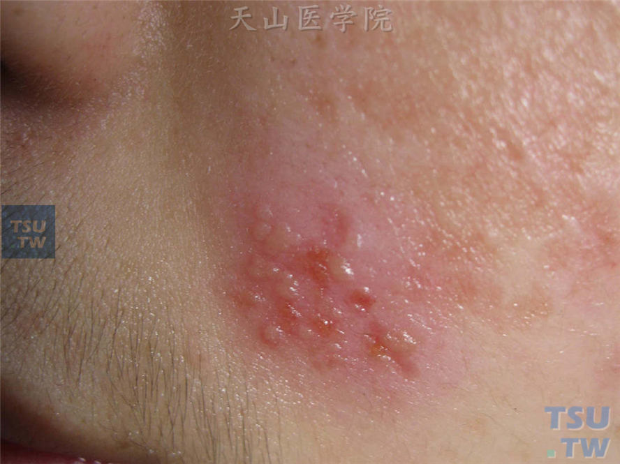 左侧面颊红斑基础上群集性水疱，部分已破溃