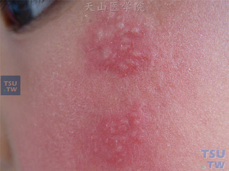 左侧面颊红斑基础上两簇群集性水疱（原发型单纯疱疹）