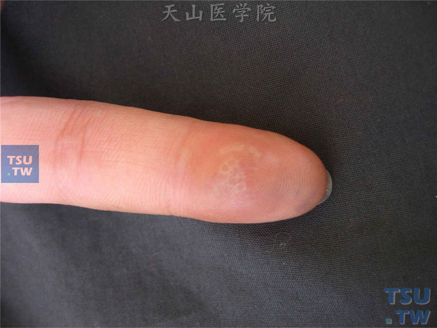 疱疹性瘭疽：食指末节指腹红斑基础上群集性水疱，密集无融合