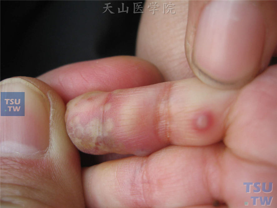 食指末节指腹红斑接触上密集粟粒至米粒大小水疱、脓疱，疱壁紧张