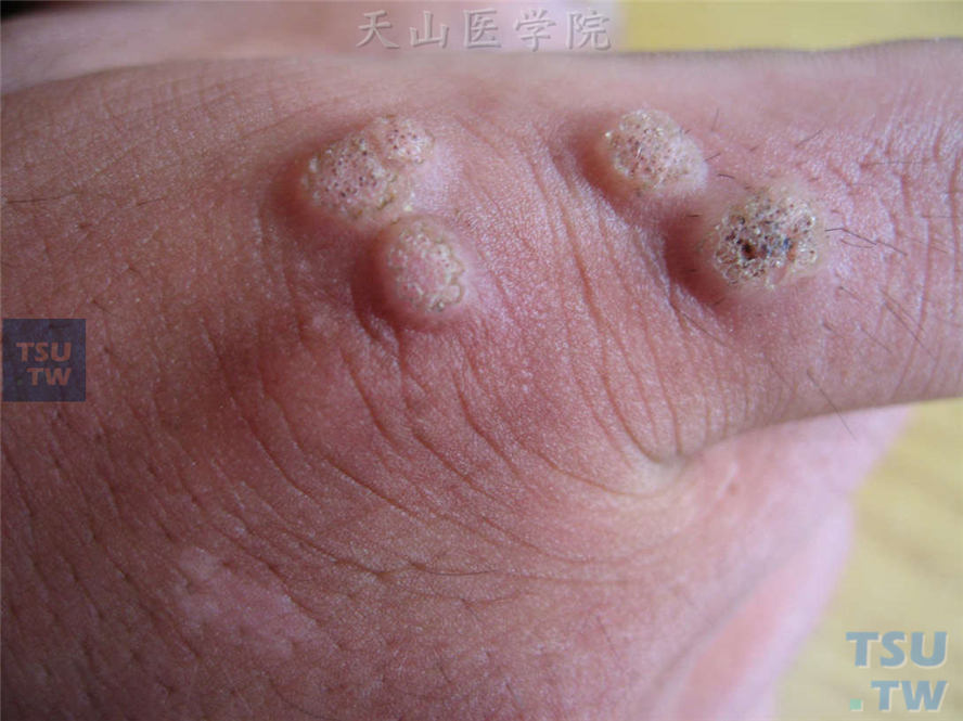 手指、手背角化性丘疹，表面粗糙，触之较硬，表面中央针尖大小出血点