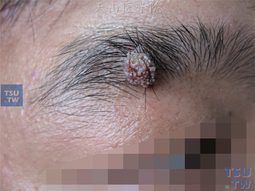 右眉角化性丘疹，表面乳头瘤样增生