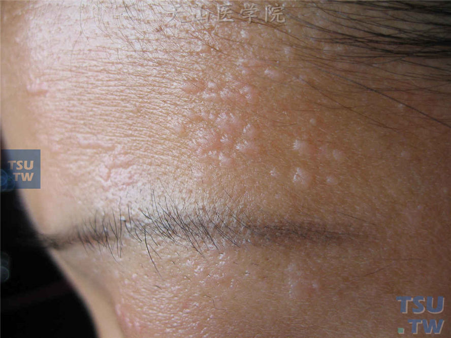 EVは予防できるのか?