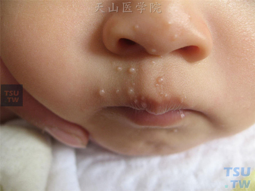 小儿鼻周、口周珍珠色圆形丘疹，表面光滑有光泽
