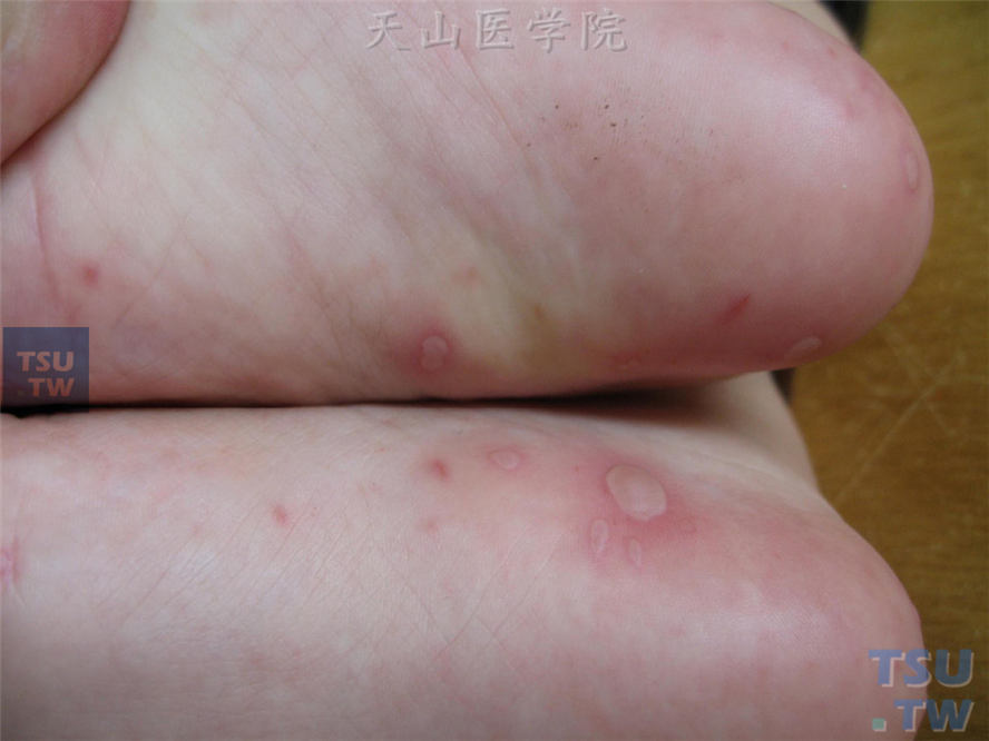 手足口病（hand-foot-mouth disease）症状表现