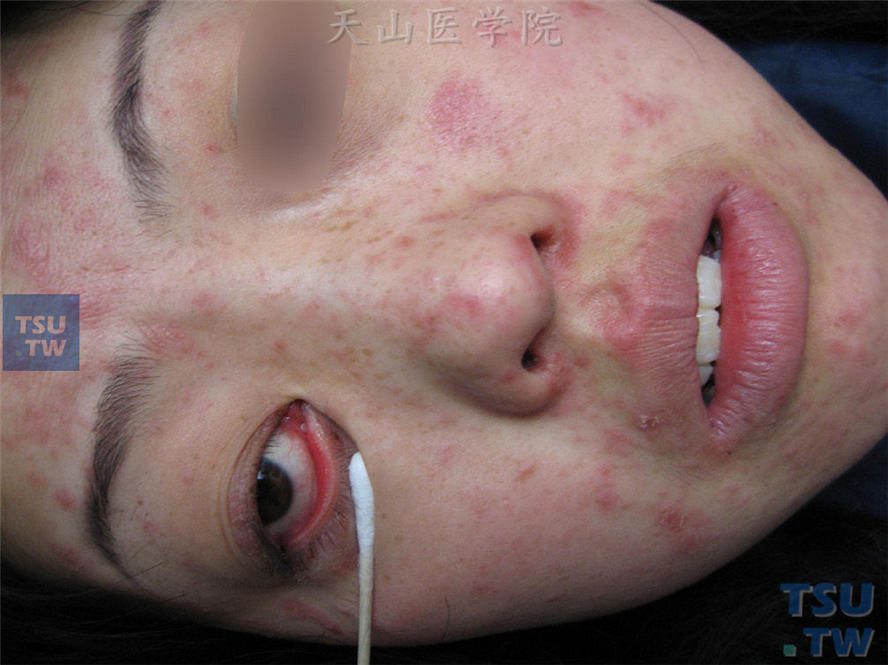 成人麻疹，面部红斑，部分融合，结膜充血