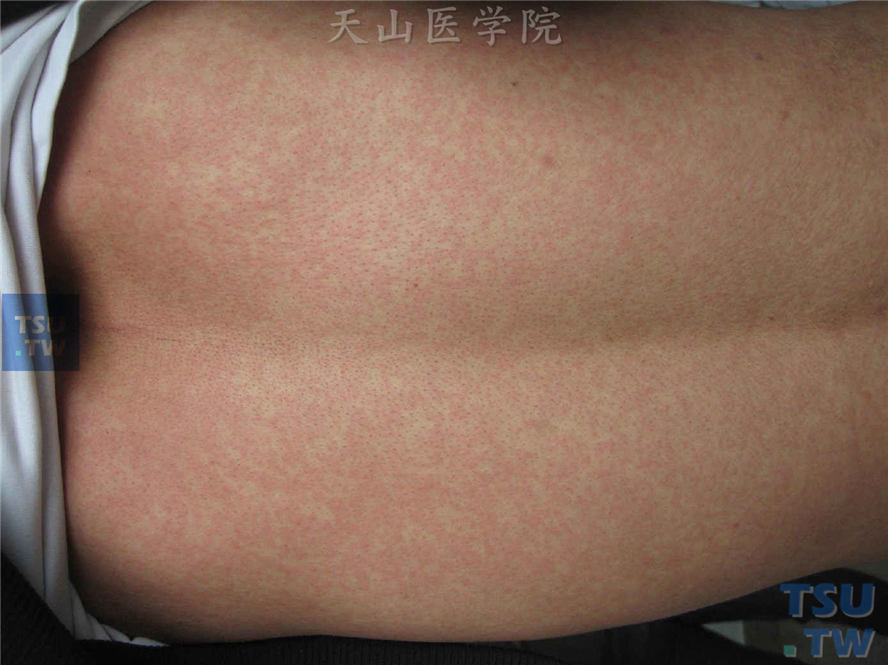 出疹高峰时皮疹数目明显增多，聚集融合成片，色泽也渐转暗，但疹间皮肤仍属正常