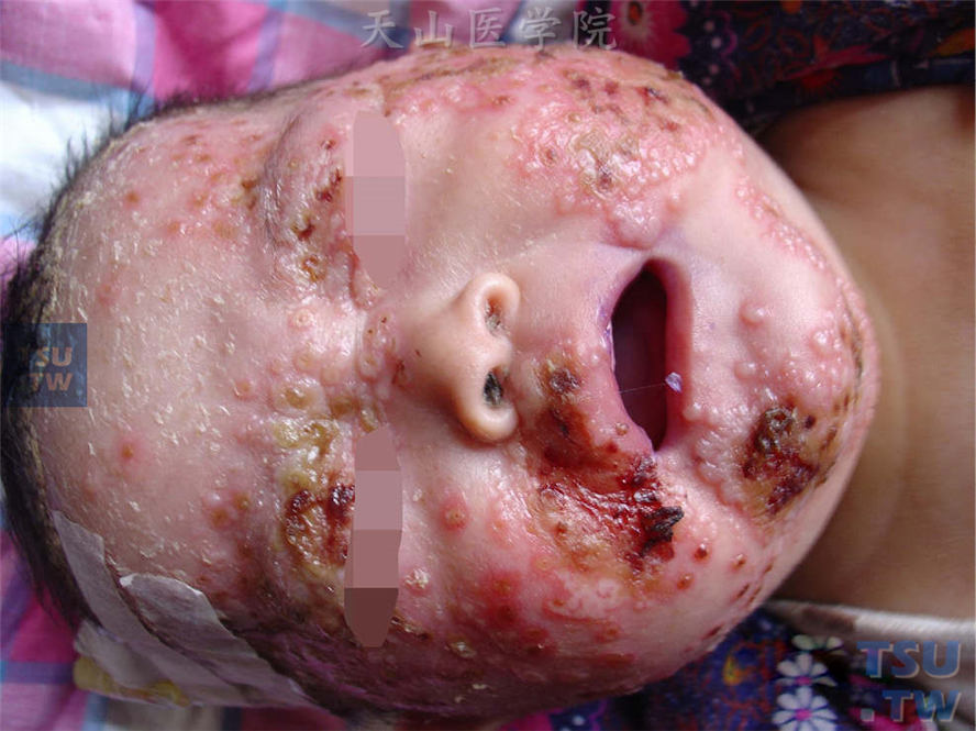 湿疹基础上多数密集绿豆粒大小水疱、脓疱，基底红肿，部分疱顶有脐窝状凹陷