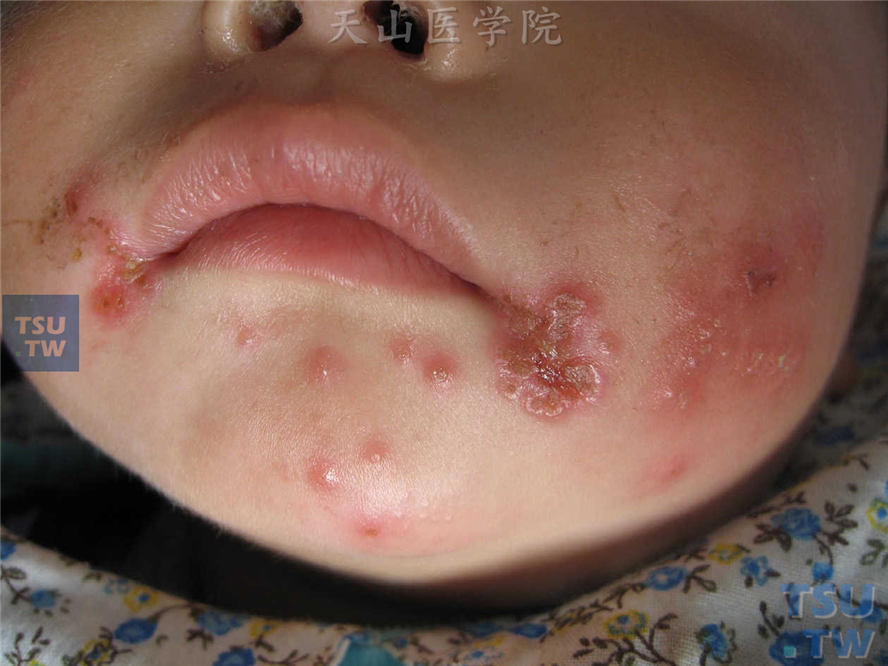 口周皮炎基础上发生单纯疱疹样皮损
