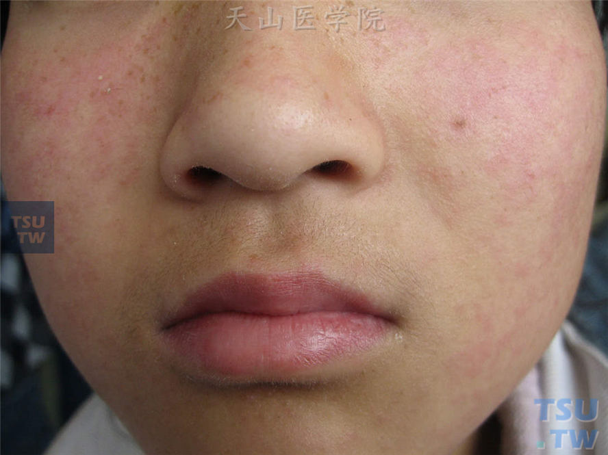患者面部散在淡红色斑丘疹